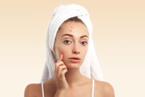 Saiba porque a maquiagem pode contribuir para o surgimento de espinhas e veja como prevenir acne. Encontre soluções eficazes para uma pele limpa e bonita